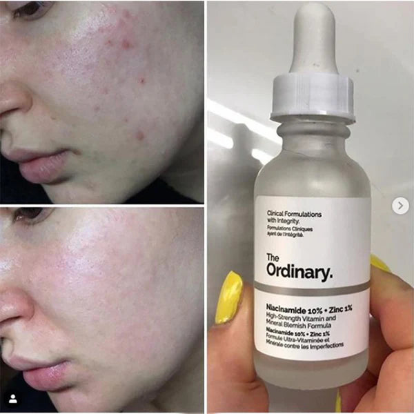 Niacinamide 10% + Zinc 1% نياسيناميد 10% زنك1% | مضاد الحبوب | تصغير المسام | مرطب | مضاد للتجاعيد